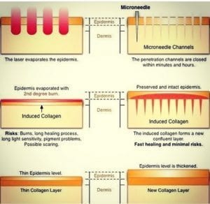 dermapen vs laser