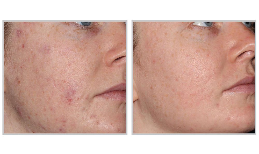 acne clinic vancouver, acne laser treatment vancouver, acne treatment vancouver, laser scar removal vancouver, skin glow treatment