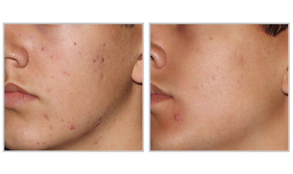 Acne Laser Treatment Vancouver | Forever Clear BBL | SkinGlow