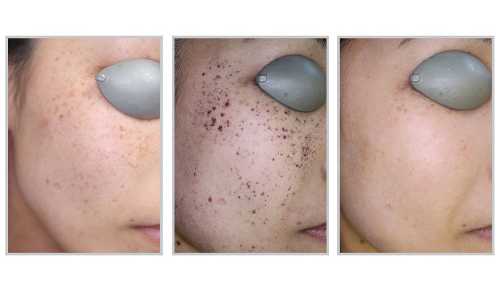 Photo Facial at SkinGlow Laser Clinic - Before/After 4