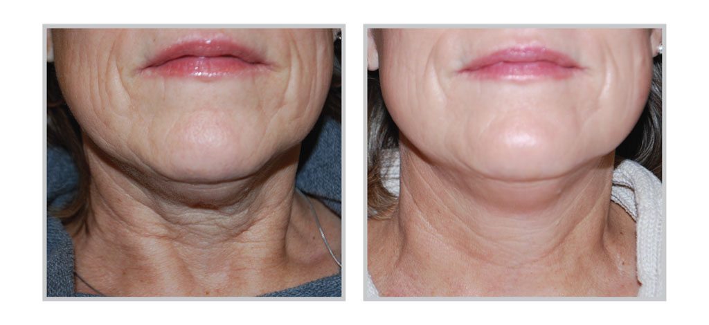 SkinTyte - Skin Tightening Treatment 2 - Before/After