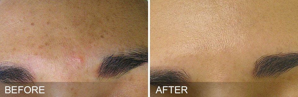 Hydrafacial Before/After Treatment 1 - Vancouver BC
