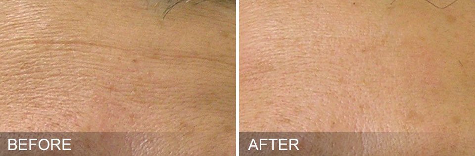 Before/After Hydrafacial Treatment 3 - In our clinic in Yaletown (Vancouver, BC)