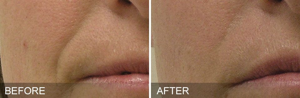 Before/After Hydrafacial Treatment 2