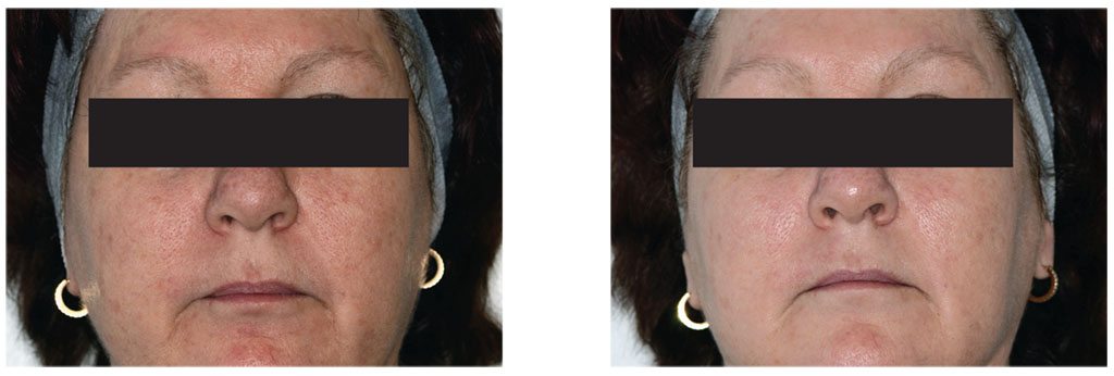 Clinical Peels - Before/After - Treatment in Our Clinic in Vancouver