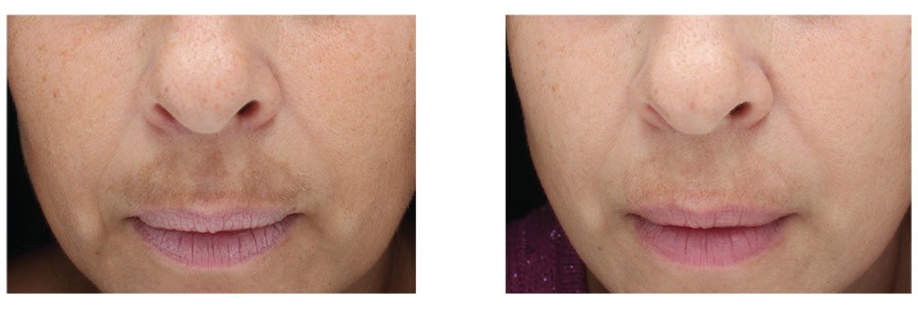 Clinical Peel Treatment 1 - Before and After Photos