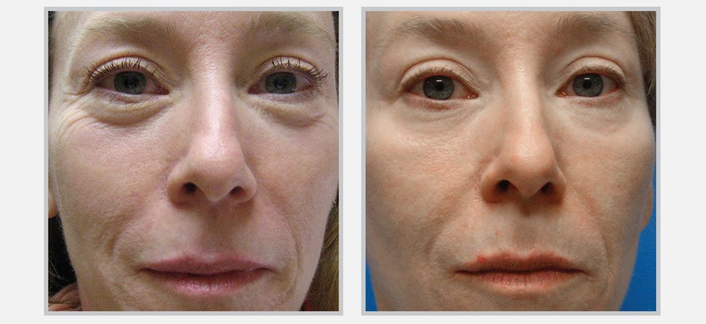 Skin Tightening - SkinGlow Skin Care Clinic Vancouver Before/After