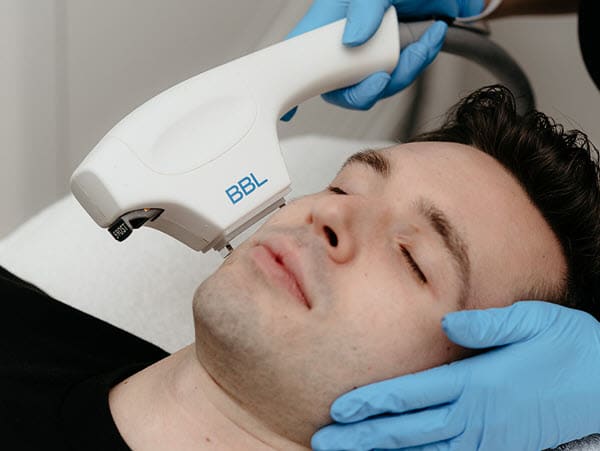 Acne Laser Treatment - Face