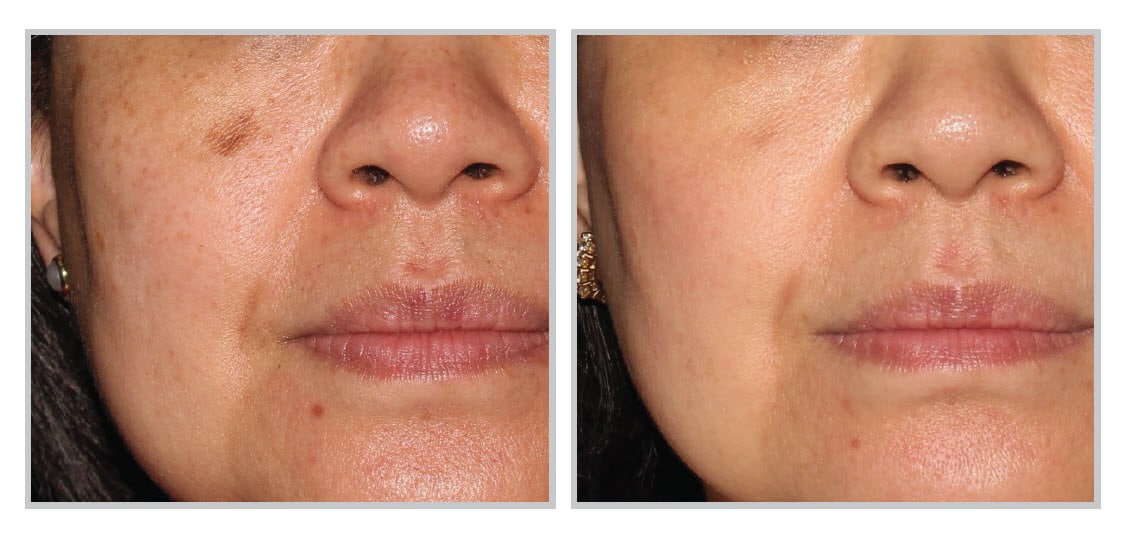 BBL HERO - Forever Young BBL Plus - Before and After Two Treatments - Face