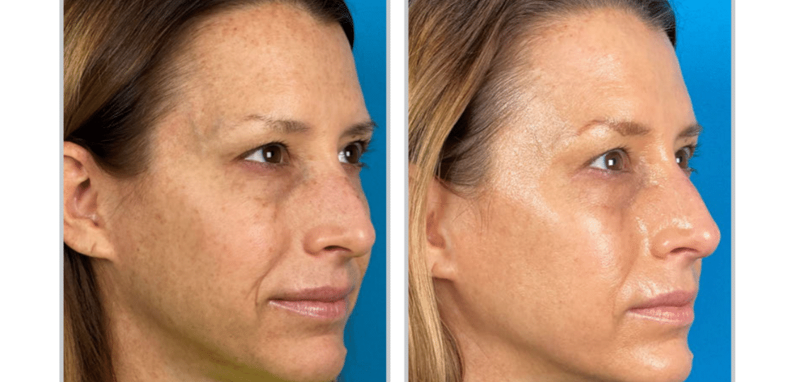 HALO Laser Treatment - Before and After - 3 weeks post 1 Treatment