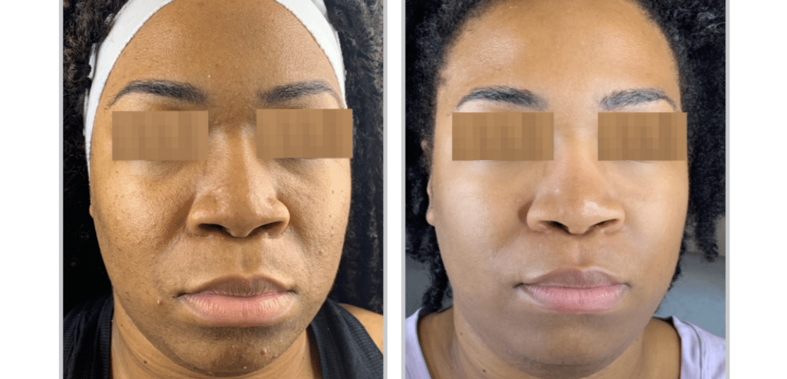 HALO Laser Treatment - Before and After - 4 weeks post 1 Treatment