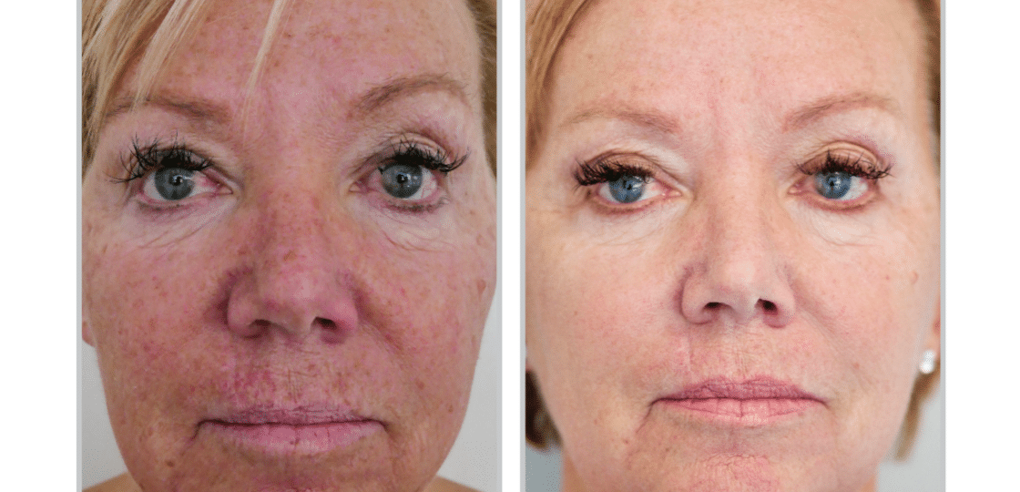 HALO Laser Treatment - Before and After - 5 Months Post 2 Treatments