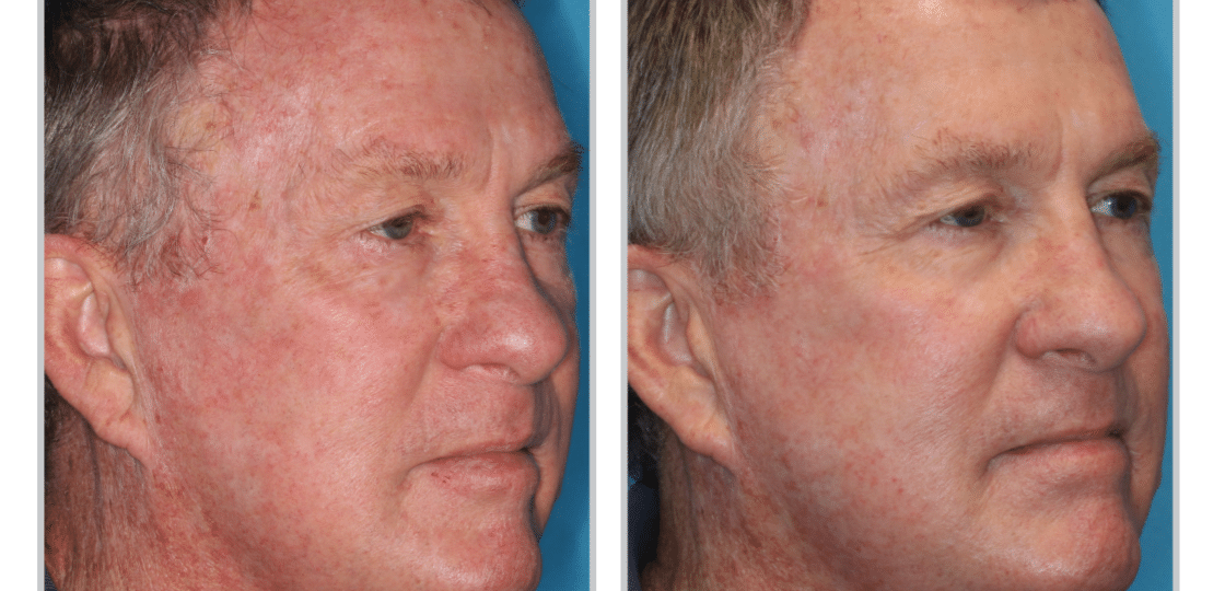 HALO Laser Treatment - Before and After - 7 weeks post 1 tx
